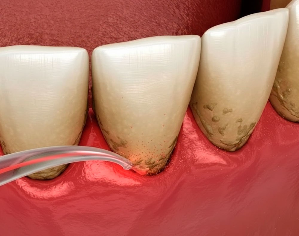 Tratamento de periodontia e limpeza