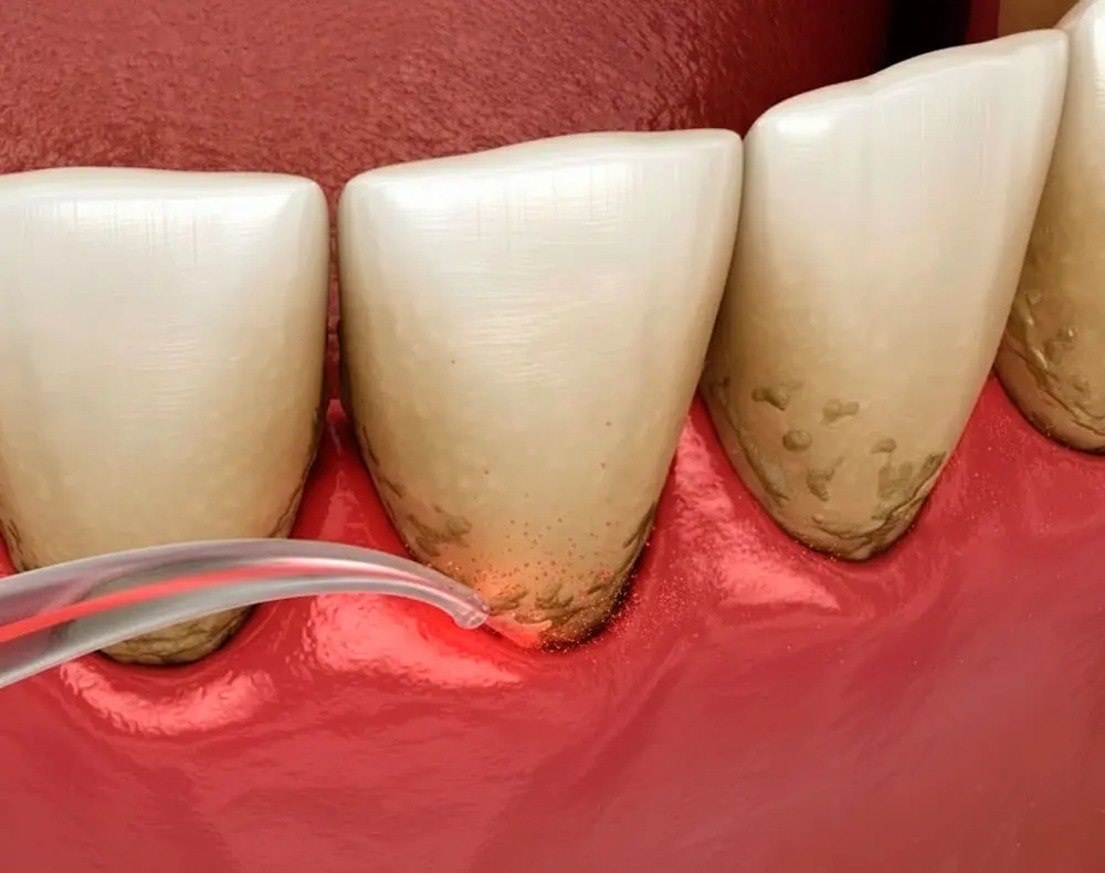 Tratamento de periodontia e limpeza
